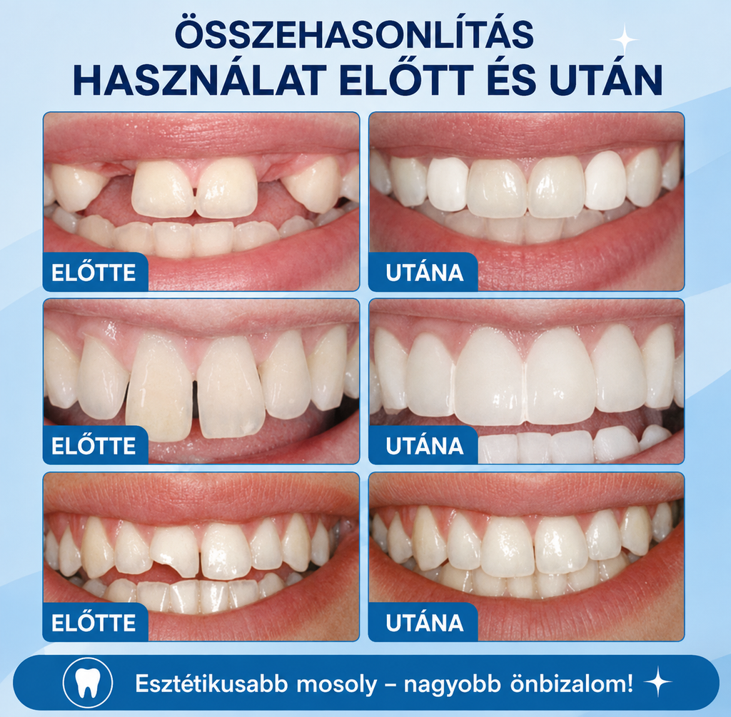 DentalKIT ProSmile™ – Formázható esztétikai fogsor