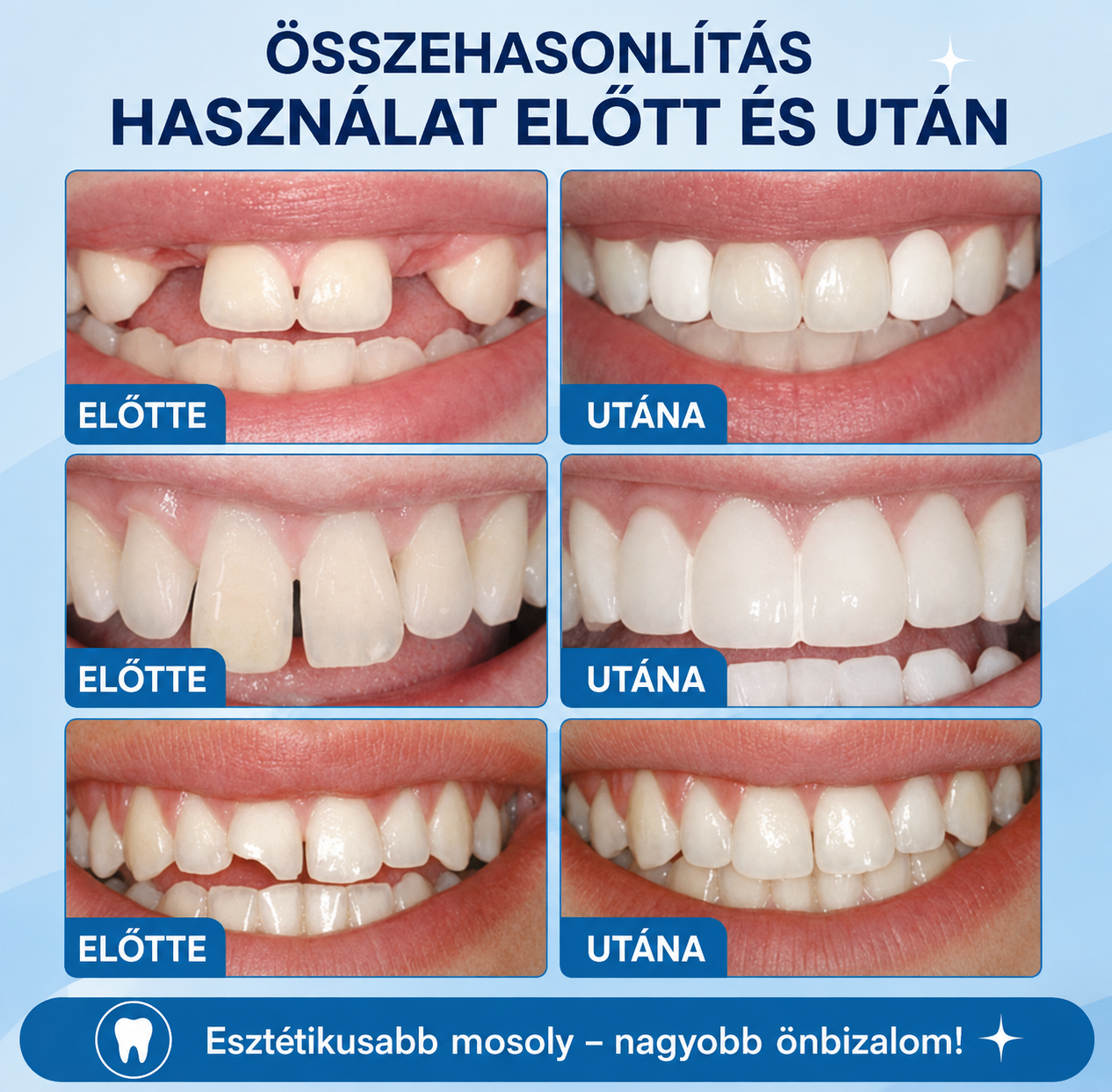 DentalKIT ProSmile™ – Formázható esztétikai fogsor