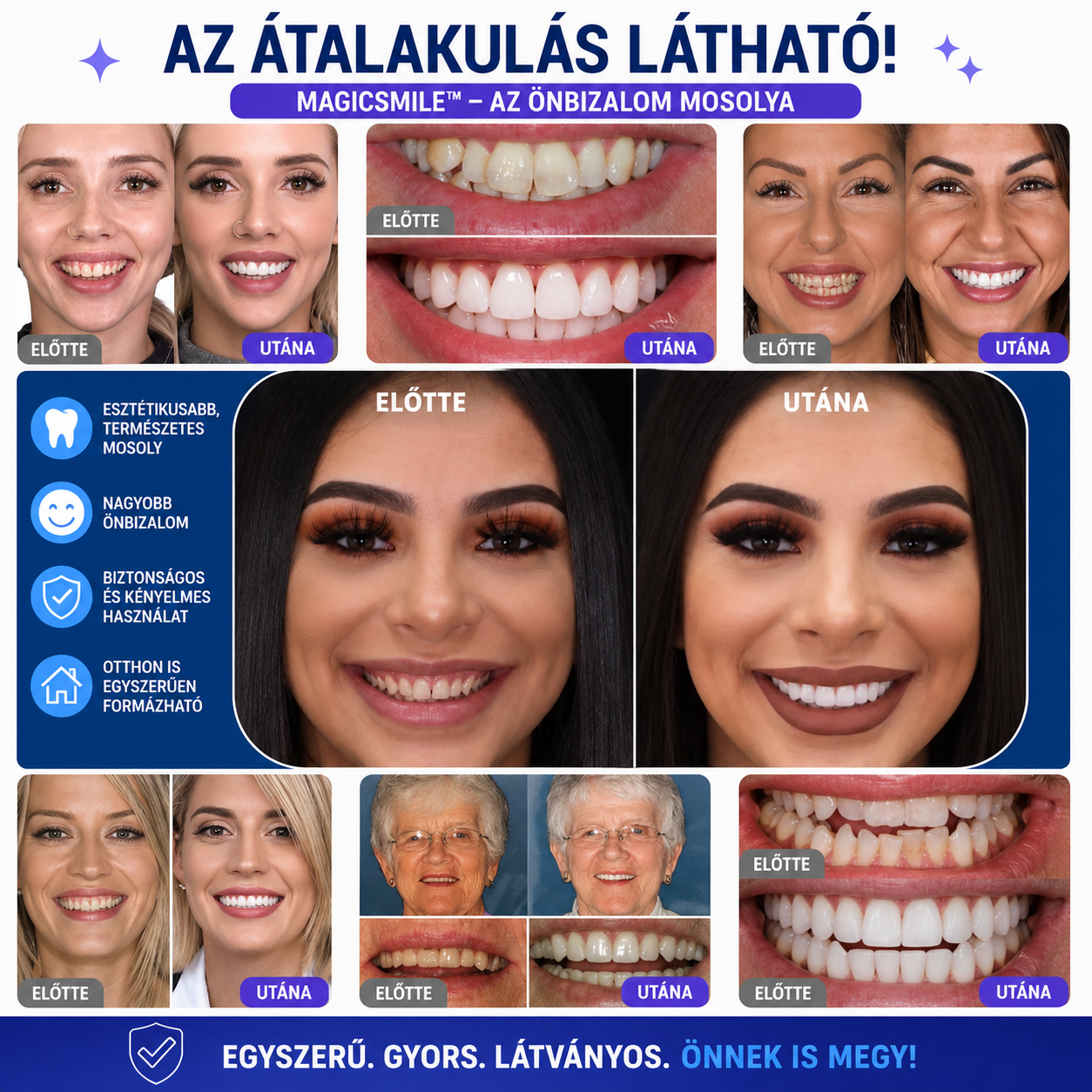 MagicSmile™ – Formázható Esztétikai Fogborítás