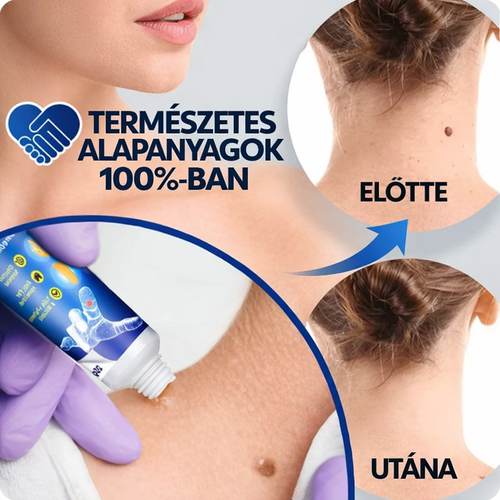 WartRemover – Szemölcs és bőrkeményedés elleni krém