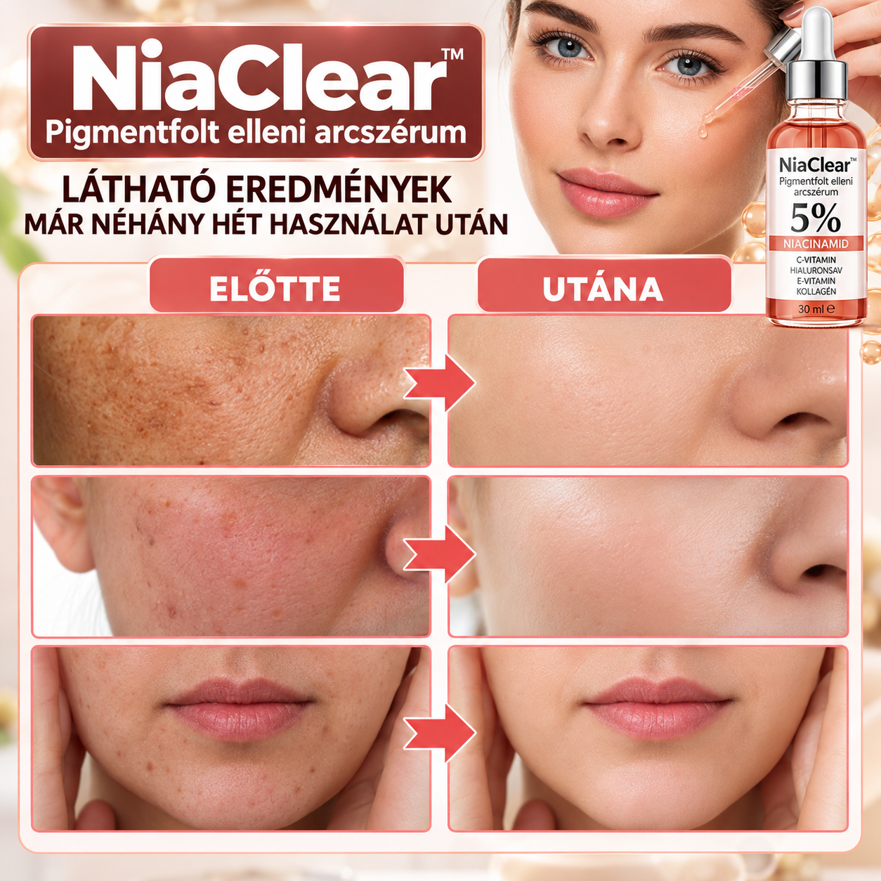 NiaClear™ – Pigmentfolt elleni arcszérum