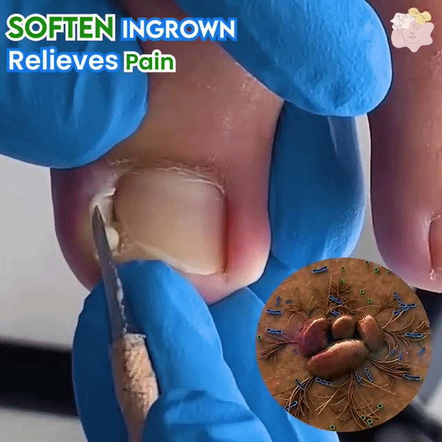 ToenailPlus™ regeneráló olaj sérült és benőtt körmökre